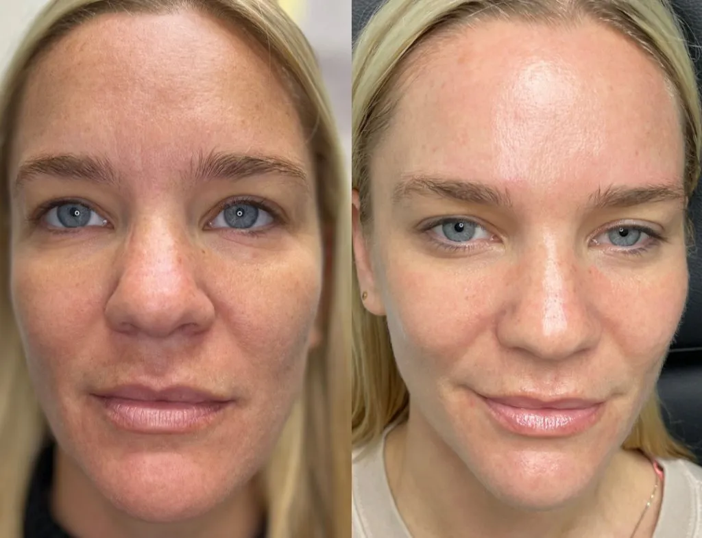 Vampire Procedure Training