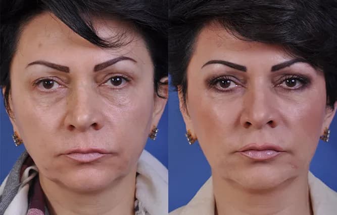 Vampire Facelift non-surgical facial rejuvenation procedure