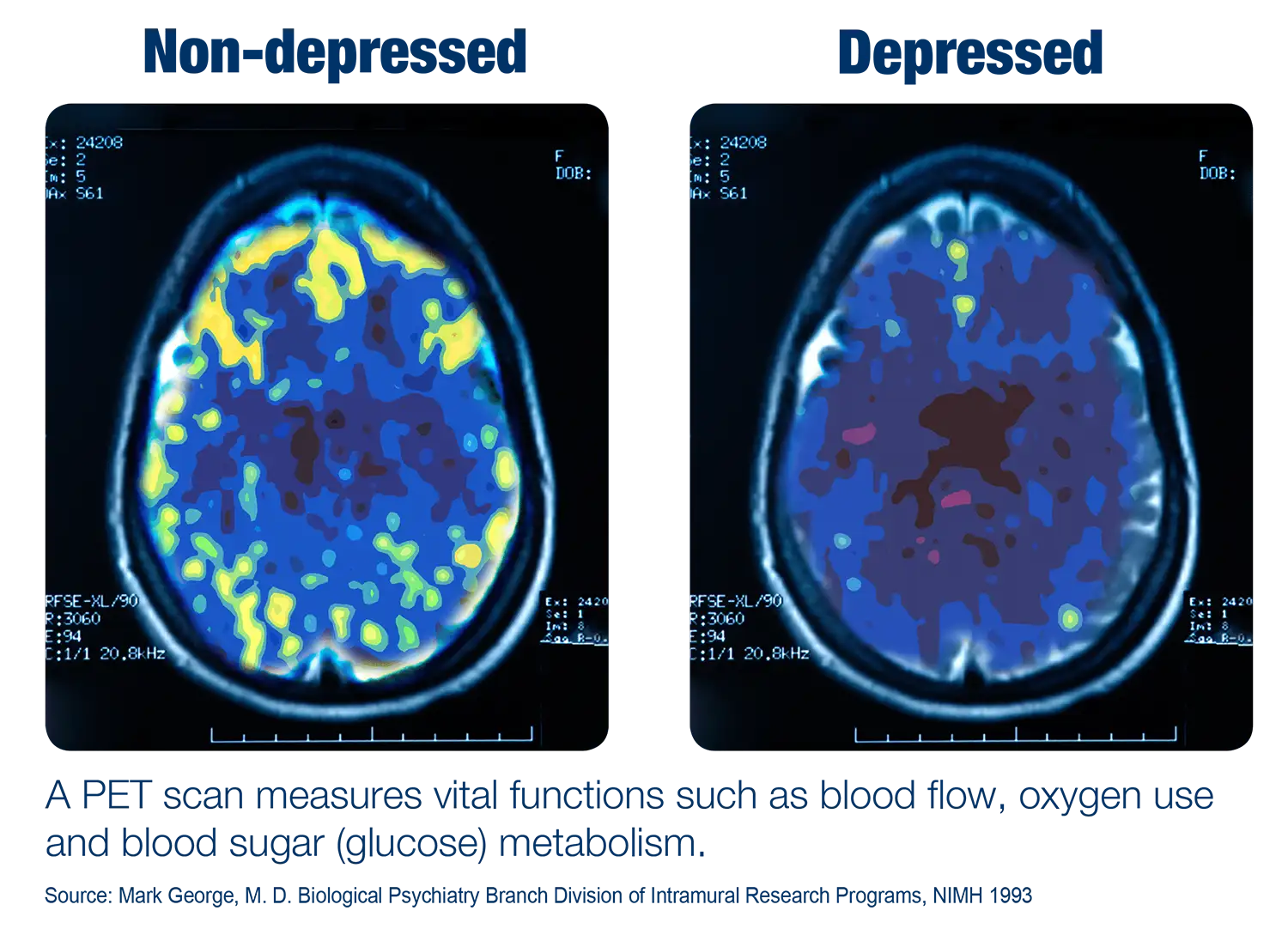 Transcranial Magnetic Stimulation Therapy
